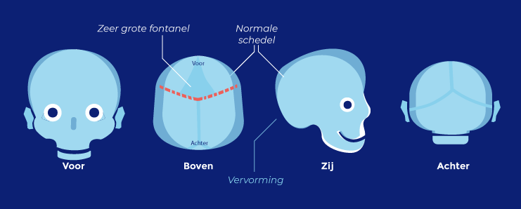 Schedelvorm Apert syndroom 