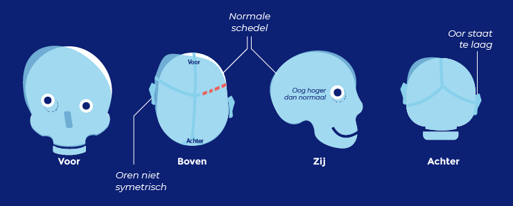 Scheef voorhoofd schedels