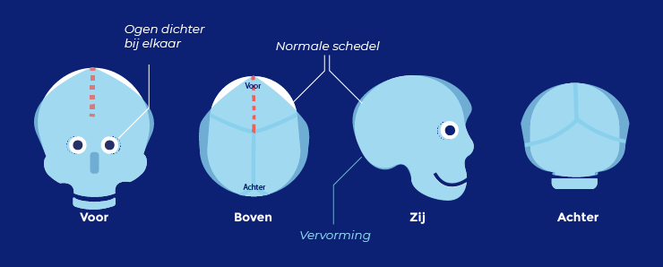 wigschedel schedelvorm