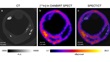 Molecular Imaging of Atherosclerosis