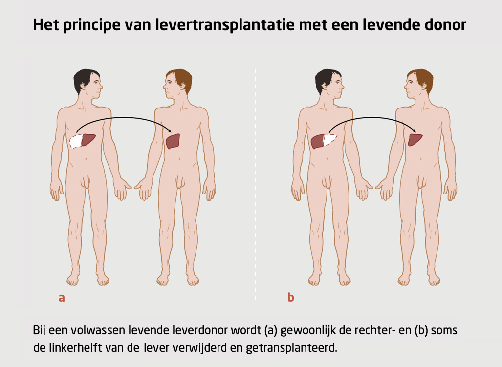 Levende leverdonor schematische tekening